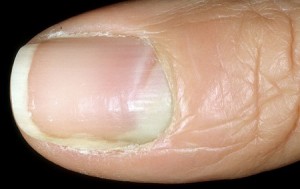 Лечение грибка ногтей в Ростове, батайске