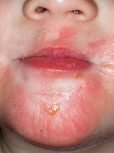 атопический дерматит у детей мед-сайт в новость